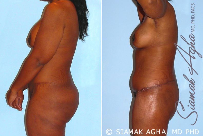 Total Body Lift Before & After