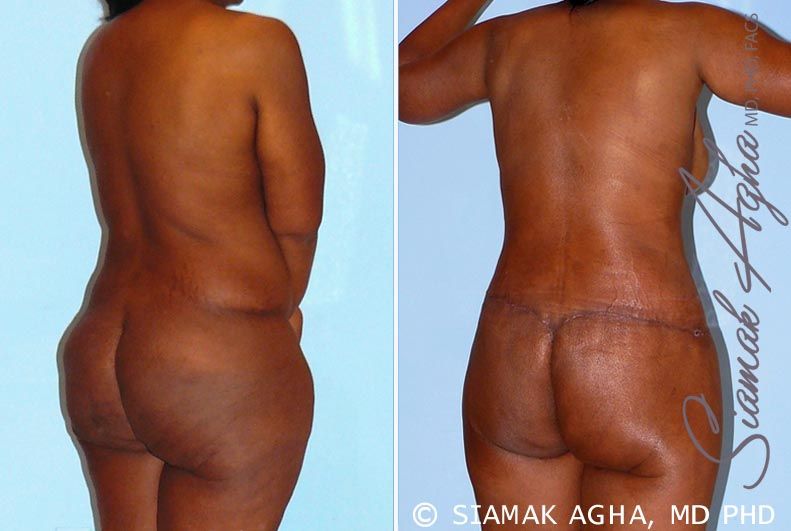 Total Body Lift Before & After