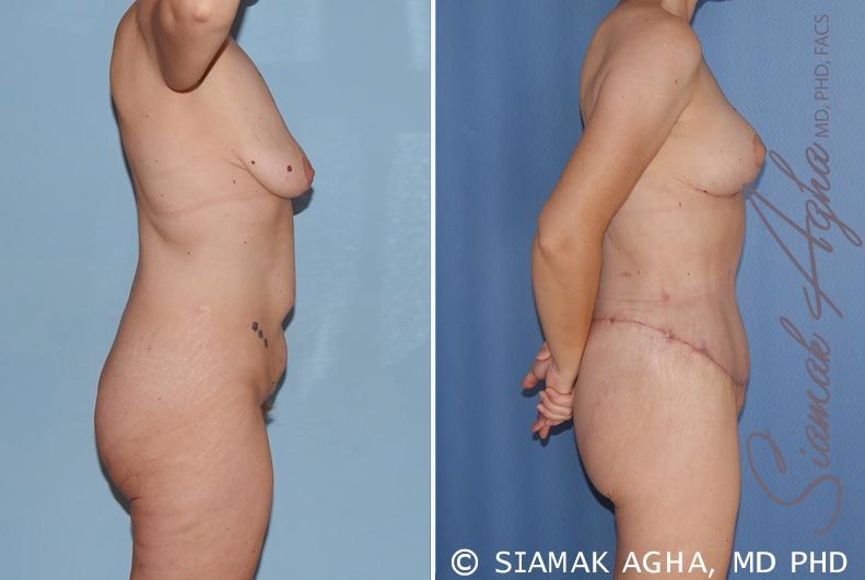 Total Body Lift Before & After