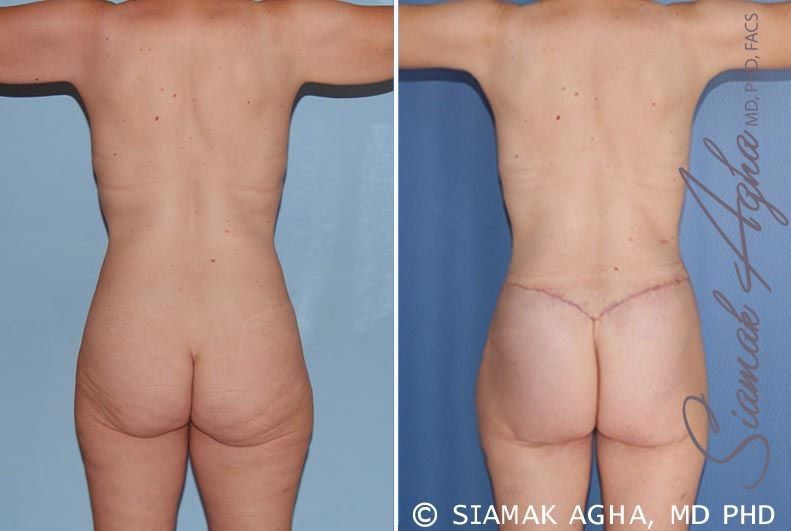 Total Body Lift Before & After