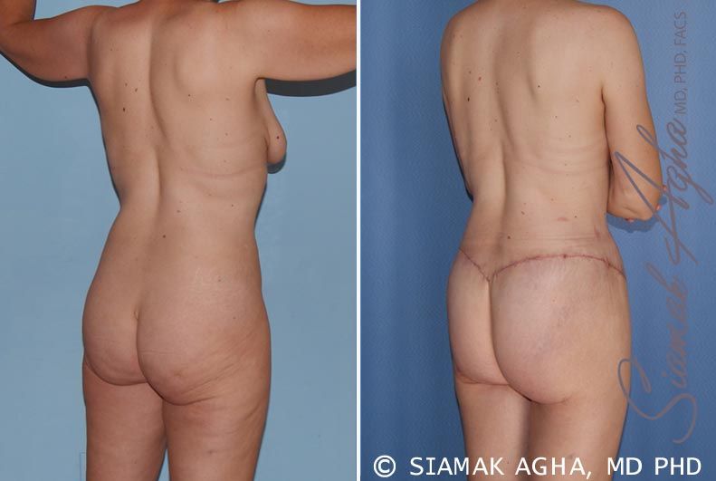 Total Body Lift Before & After