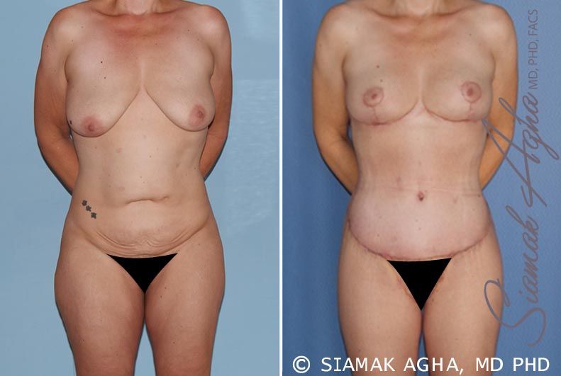 Total Body Lift Before & After