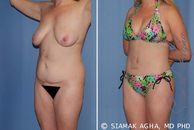 Total Body Lift Before & After