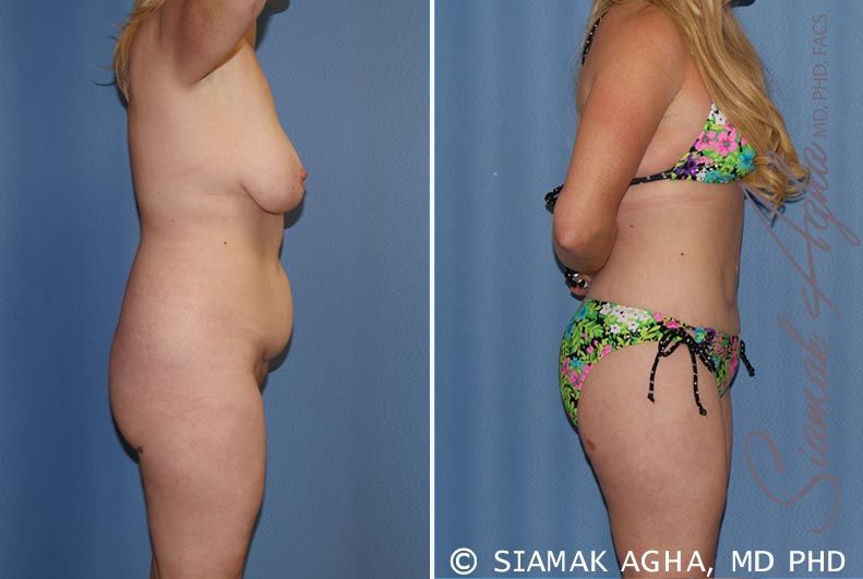 Total Body Lift Before & After