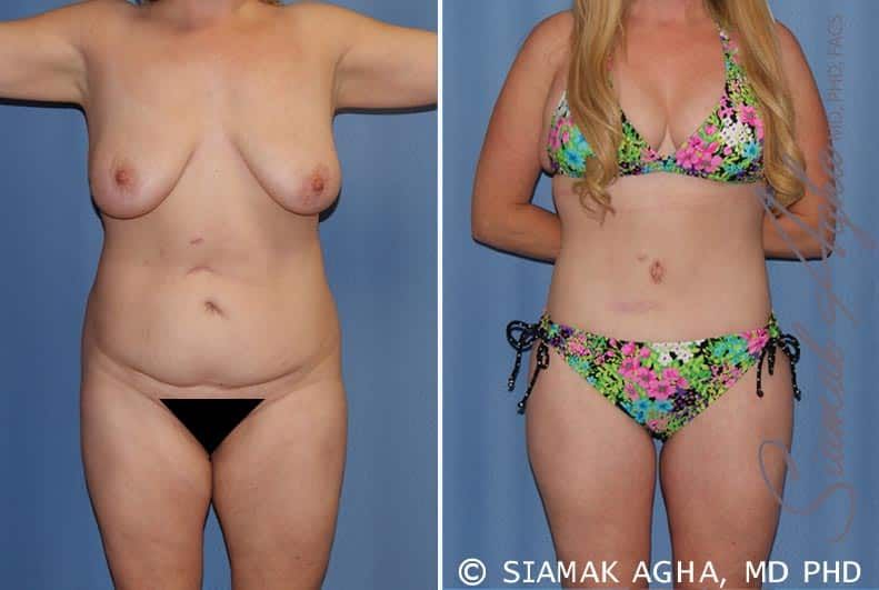 Total Body Lift Before & After