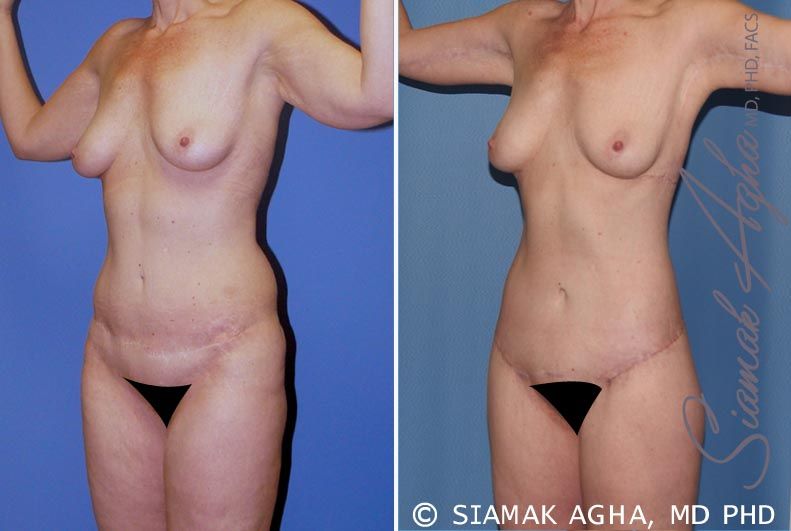 Total Body Lift Before & After