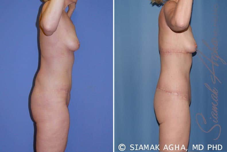 Total Body Lift Before & After