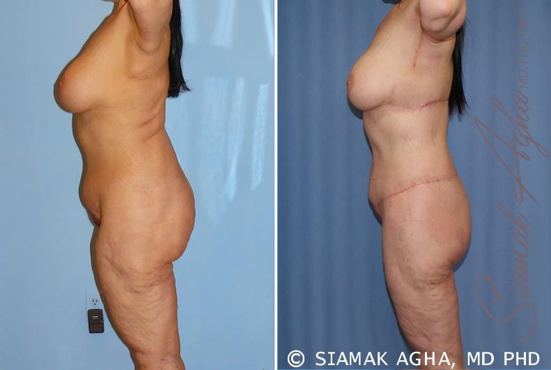 Total Body Lift Before & After