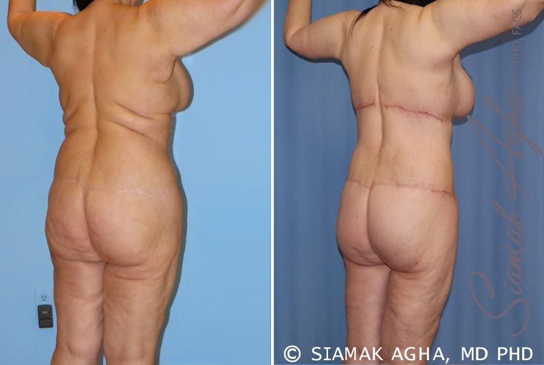 Total Body Lift Before & After