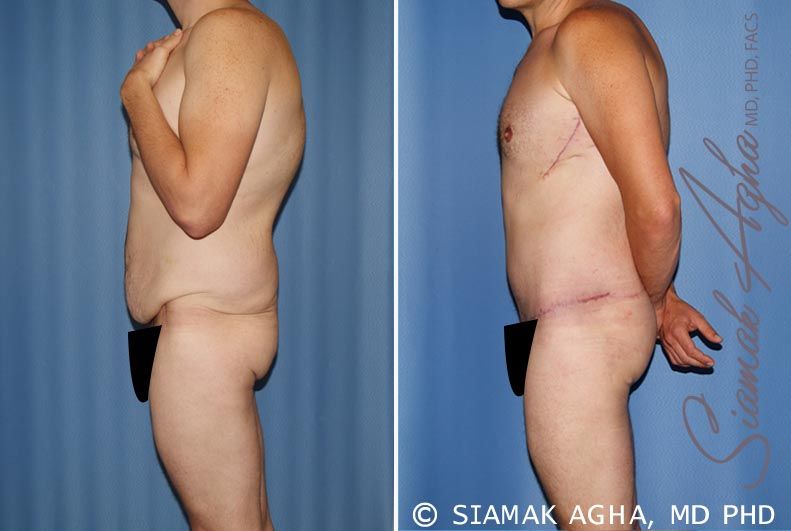 Total Body Lift Before & After