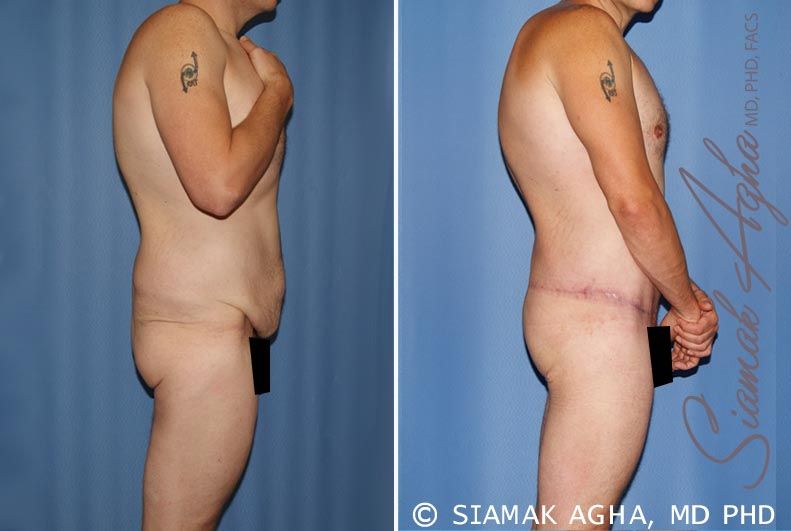 Total Body Lift Before & After