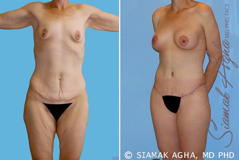 Total Body Lift Before & After