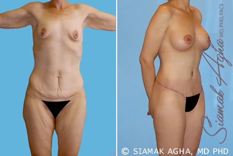 Total Body Lift Before & After