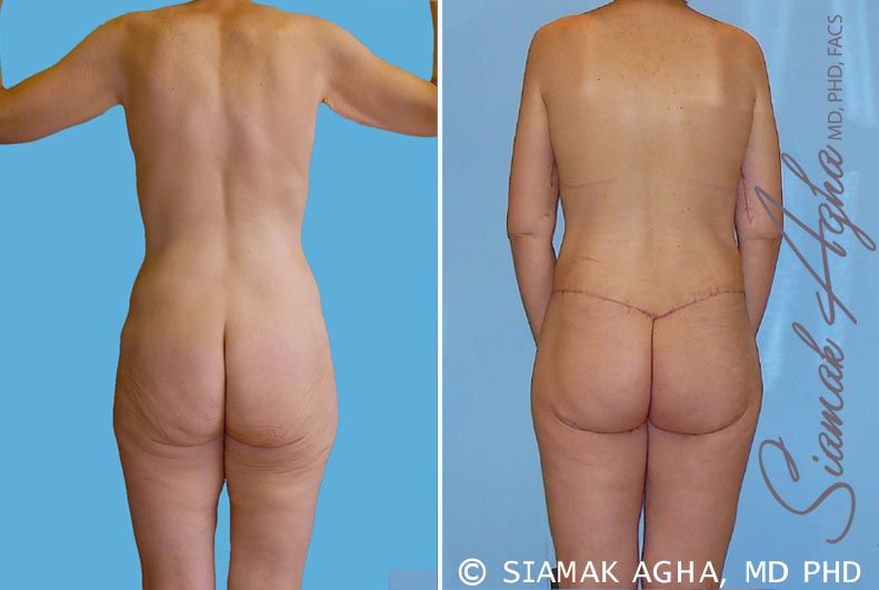 Total Body Lift Before & After