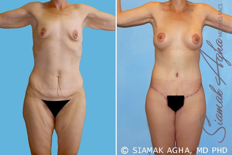 Total Body Lift Before & After