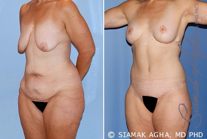 Total Body Lift Before & After