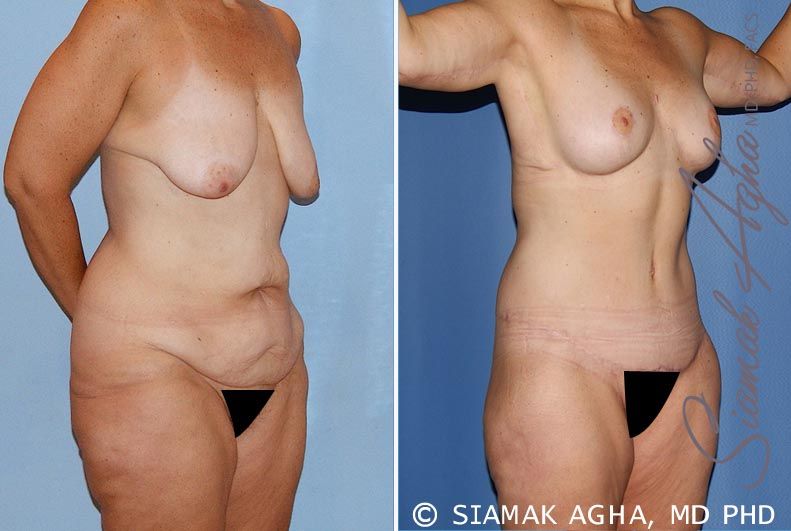 Total Body Lift Before & After