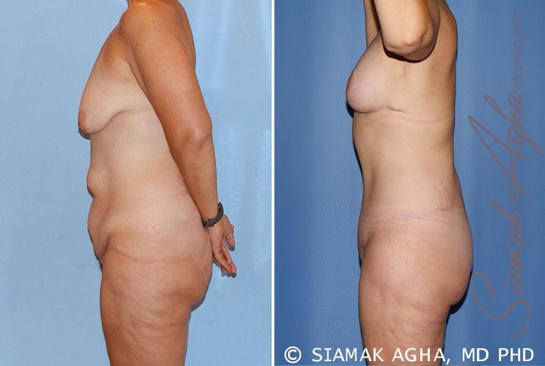 Total Body Lift Before & After