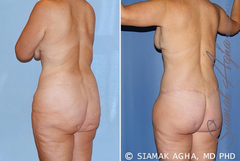 Total Body Lift Before & After