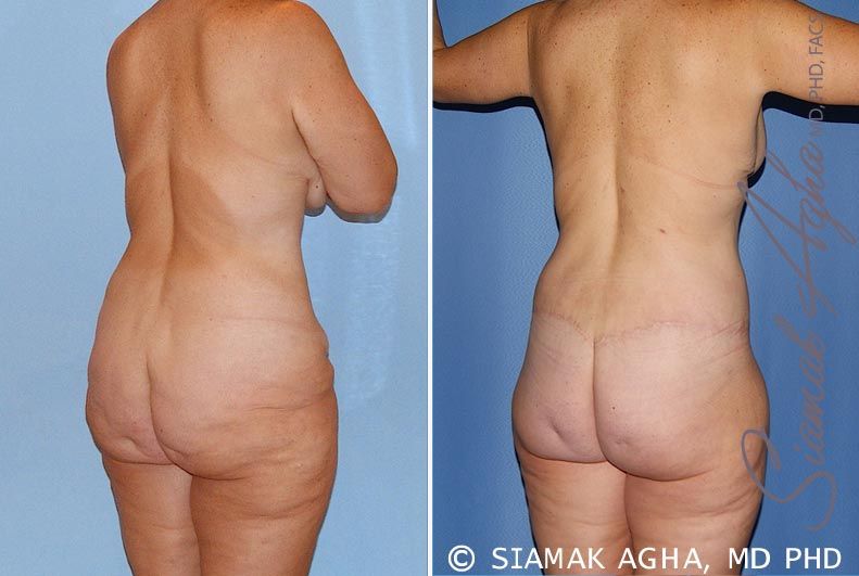Total Body Lift Before & After