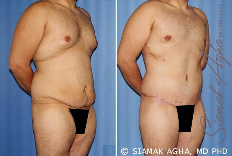 Total Body Lift Before & After
