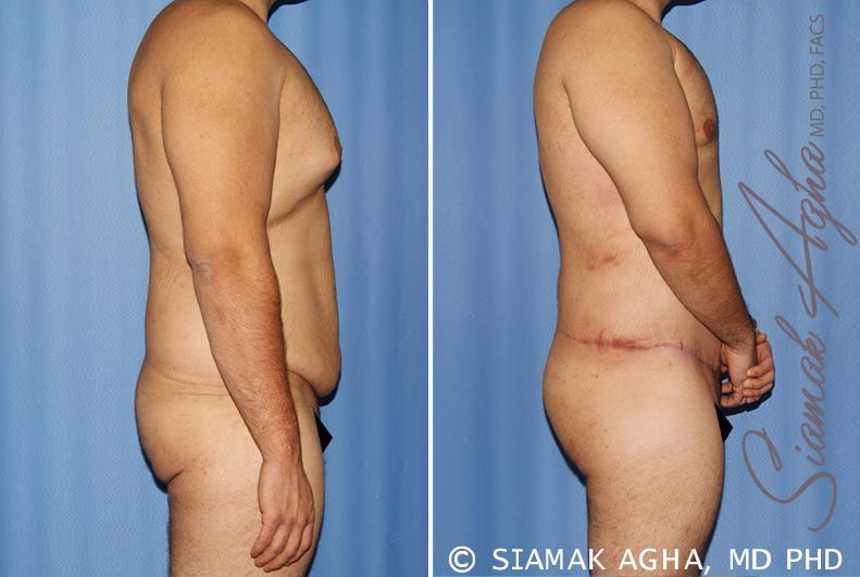 Total Body Lift Before & After