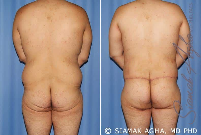 Total Body Lift Before & After