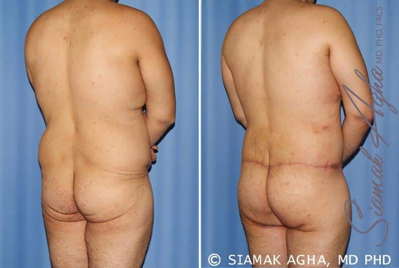 Total Body Lift Before & After
