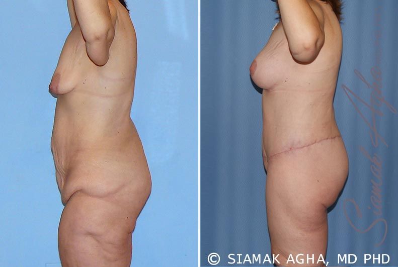 Total Body Lift Before & After