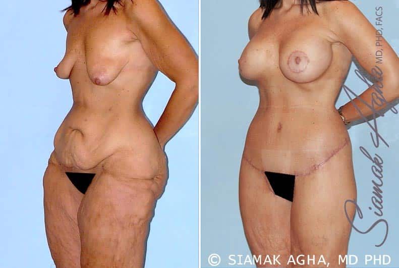 Total Body Lift Before & After