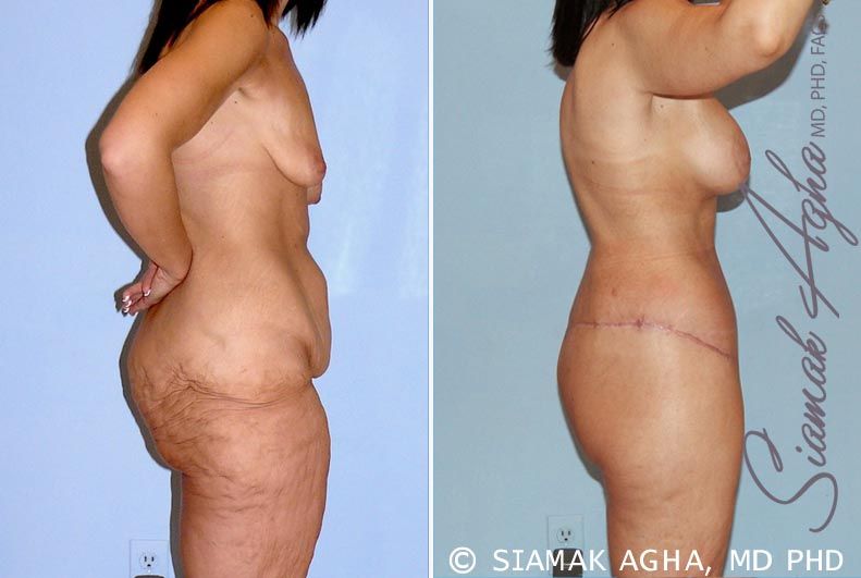 Total Body Lift Before & After