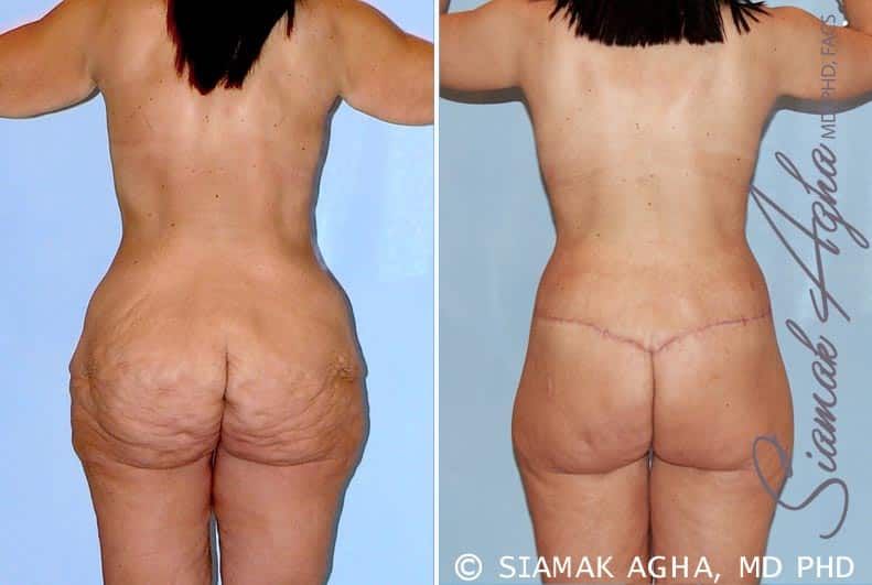 Total Body Lift Before & After