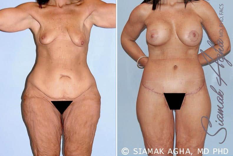 Total Body Lift Before & After