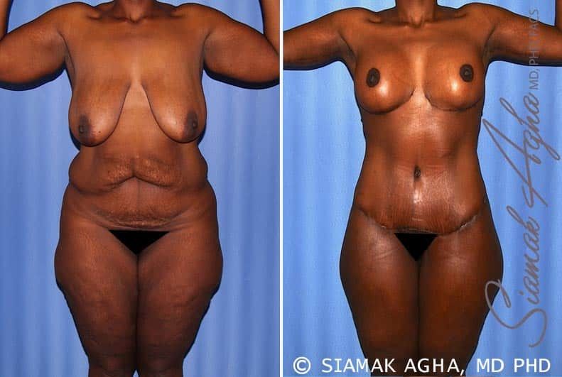 Total Body Lift Before & After