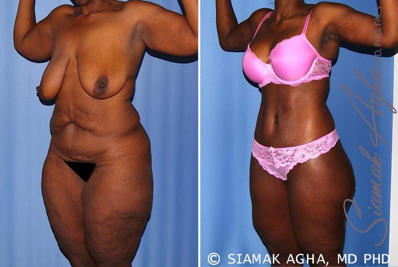 Total Body Lift Before & After