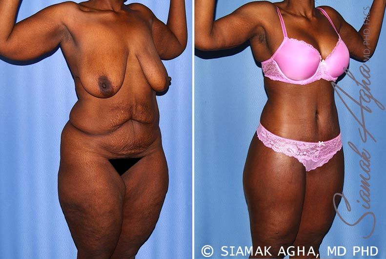 Total Body Lift Before & After