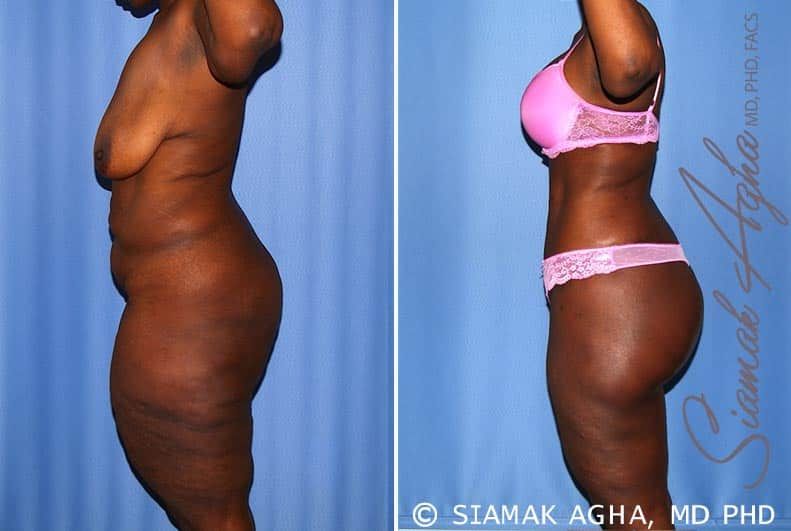 Total Body Lift Before & After