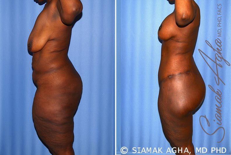 Total Body Lift Before & After