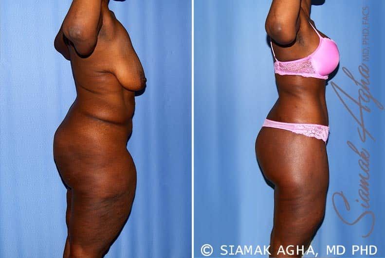 Total Body Lift Before & After