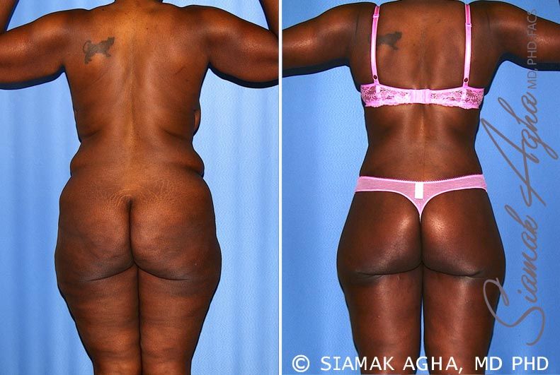 Total Body Lift Before & After