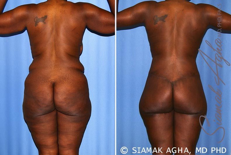 Total Body Lift Before & After