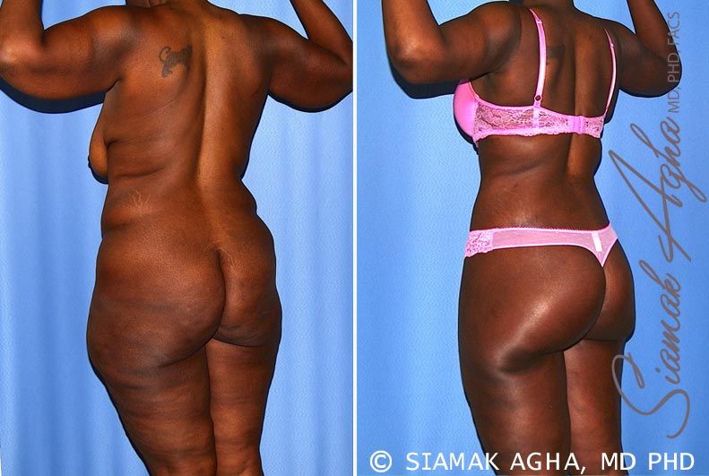 Total Body Lift Before & After