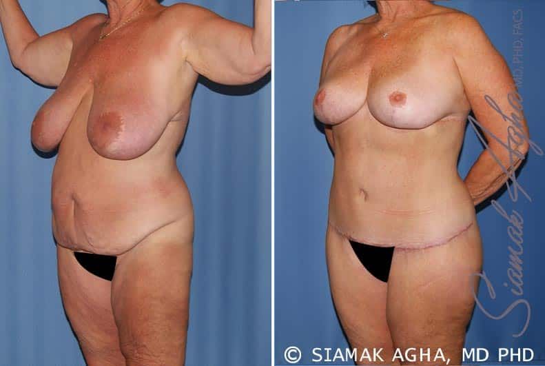 Total Body Lift Before & After