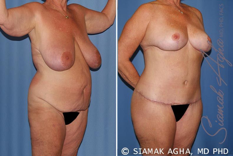 Total Body Lift Before & After