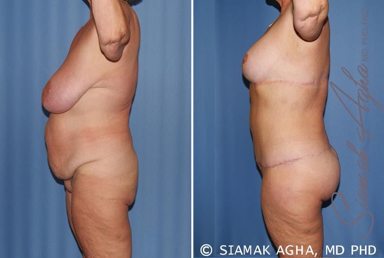 Total Body Lift Before & After