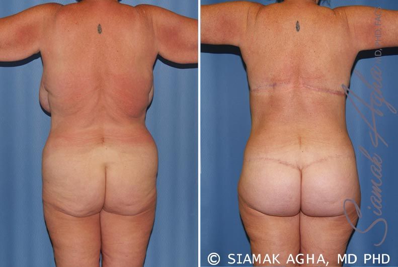 Total Body Lift Before & After