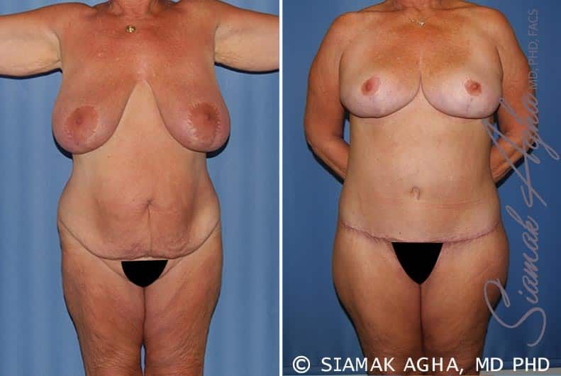 Total Body Lift Before & After