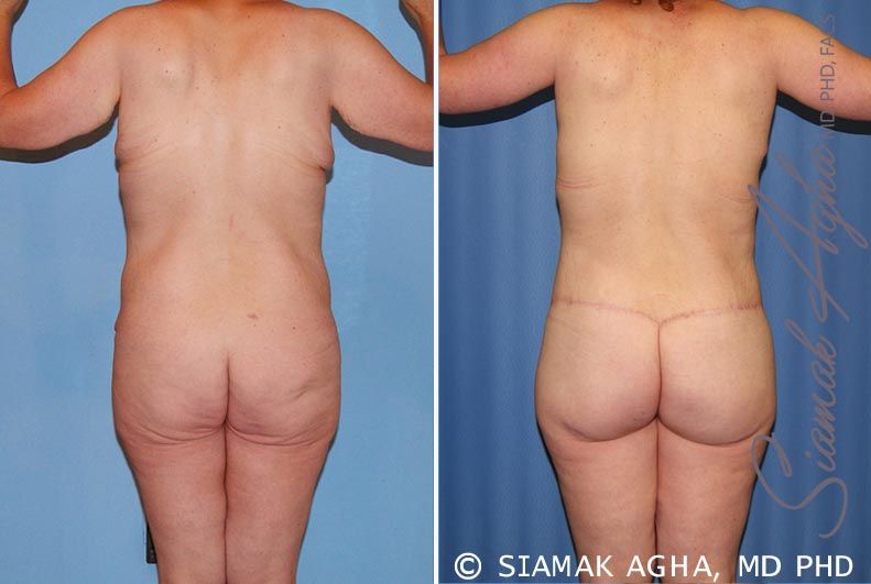 Total Body Lift Before & After