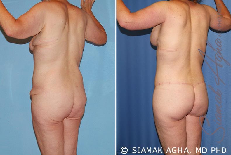 Total Body Lift Before & After