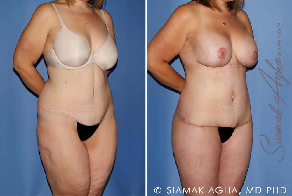 Total Body Lift Before & After